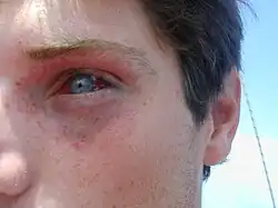 Eye and surrounding skin of young male showing petechial and subconjunctival haemmorhages